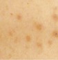 治癒後に茶色く、シミのように色素沈着を起こしてしまう茶色いシミみたいな男性ニキビ跡