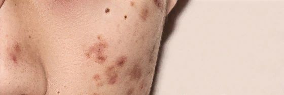 茶色いシミニキビの正体は色素沈着